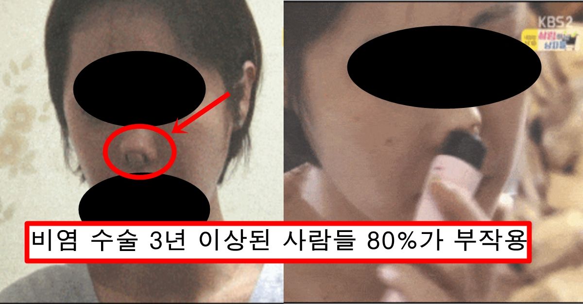 비염 수술 절대 하지말고 만약 한 사람은 3년안에 다 큰일난 이유 ㄷㄷ