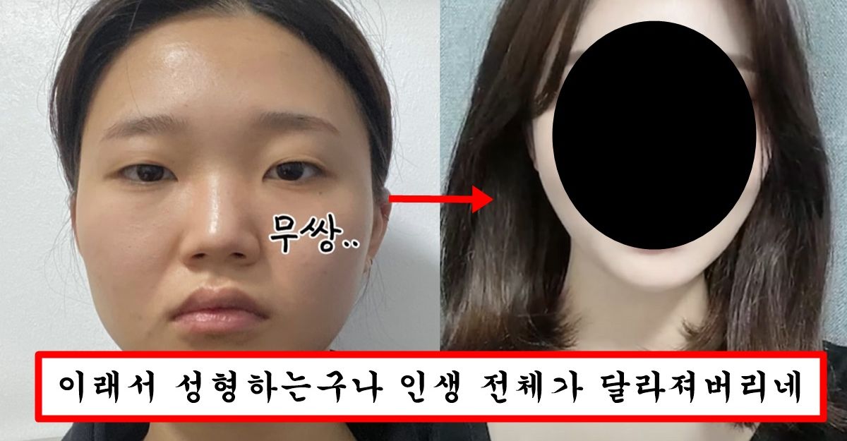 성형 하나로 얼굴 완전 바껴서 연예인 소속사까지 발벗고 나서게 한 흔한 여자의 성형 후기