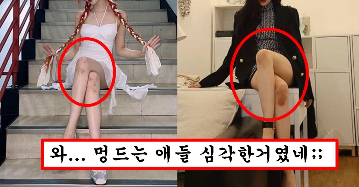 분명 부딪힌적도 없는데 여자 몸에 멍이 생기는 소름돋는 이유